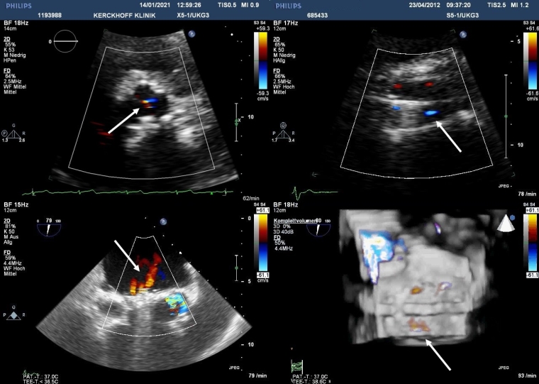 259_Brandt_Figure 1_Prosthetic heart valves Part 3 &ndash; Imaging.jpg