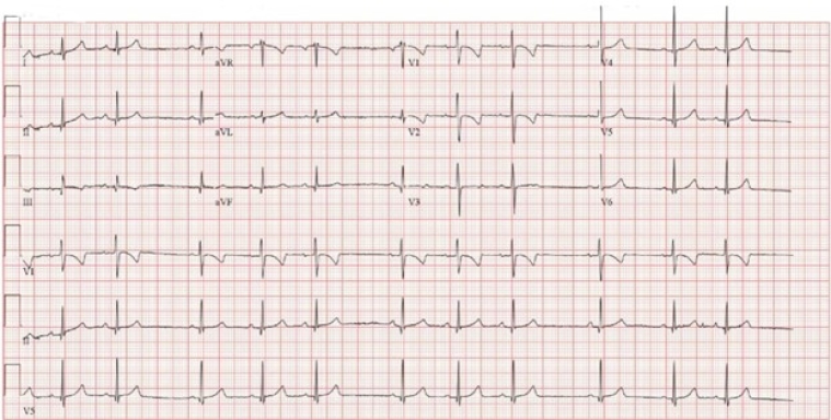 Vol 11 Figure 2. ECG at 12 month old._Cardiovascular involvement.jpg