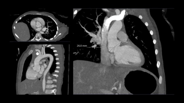 Vol 11  Figure 4. CT scan at 5 y.o. showing aorta dimension_Cardiovascular involvement.jpg
