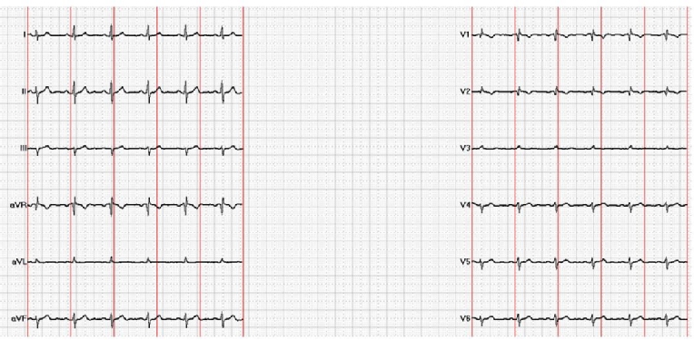CPX-Quiz-Oct-2017-Fig1-ECG_escardio-hPhotoLarge.jpg
