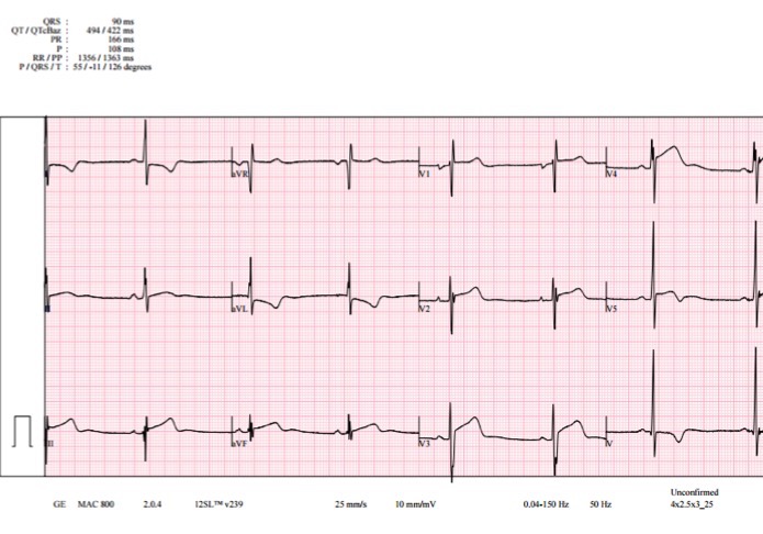 ECG_Quiz_July_2017.jpg