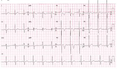 ecg-august-quiz-image_escardio-hPhotoMedium.jpg