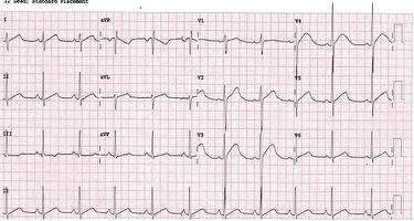 ecg-quiz-jan14_escardio-hPhotoMedium.jpg