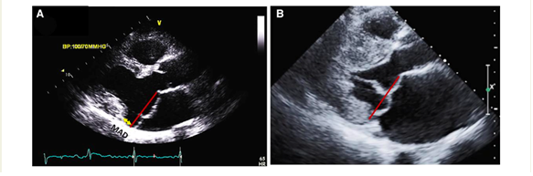 Figure 1 - How to assess mitral valve prolapse and mitral annular disjunction.png
