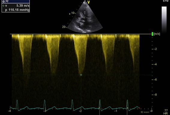 Fig 1 CC - Clinical Case - hypertrophic cardiomyopathy.jpg
