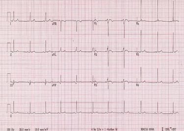 eacpr-ecg-quiz-nov-2013-web_escardio-hPhotoMedium.jpg