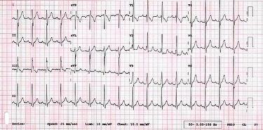 ecg-quiz-feb-2015_escardio-hPhotoMedium.jpg