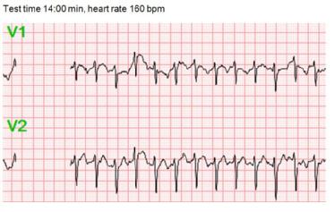 ECG during exercise 14_escardio-hPhotoMedium.jpg