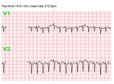 ECG during exercise 14_51_escardio-hPhotoMedium.jpg