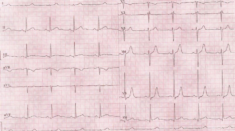2019-10-ecg-quiz5_escardio-hPhotoLarge.jpg