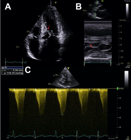 Figure 4 - How to&hellip;measure intraventricular obstruction in hypertrophic cardiomyopathy.jpg