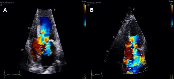 Figure 3 - How to&hellip;measure intraventricular obstruction in hypertrophic cardiomyopathy.jpg