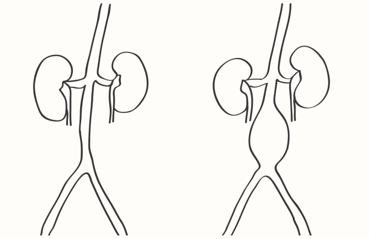 221_Knypl_Figure 1_The abdominal aortic artery aneurysm and cardiovascular risk factors.jpg
