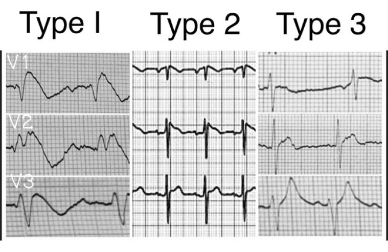 251_Figure 1_Brugada syndrome.jpg