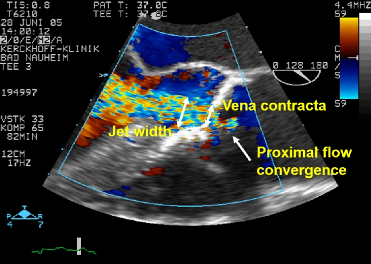 216_Brandt_Figure_1_Chronic aortic regurgitation diagnosis and therapy in the modern era.jpg