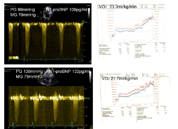 210_Karatasakis_Figure 1_Clinical features of aortic stenosis the need for exercise testing a general introduction.jpg