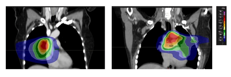 254_Aznar_Figure3-Radiotherapy and its consequences what the cardiologist should know.jpg