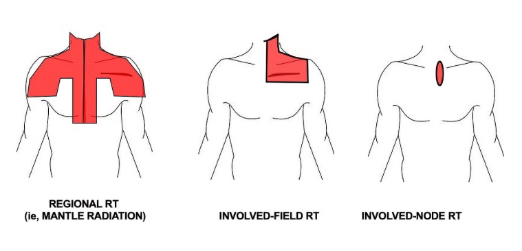 254_Aznar_Figure2-Enhanced_Radiotherapy and its consequences what the cardiologist should know.jpg