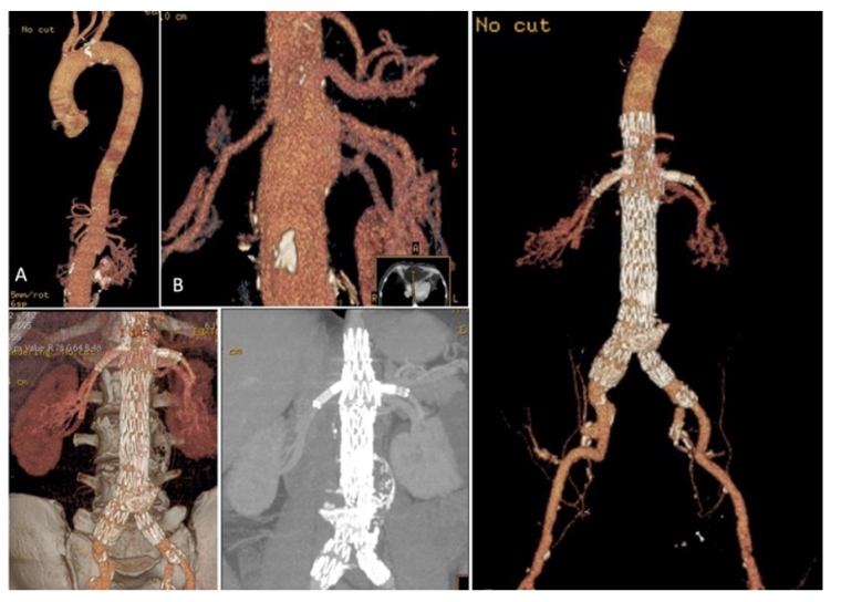 229_Fernandes_Figure 2A_Abdominal aortic aneurysms.jpg