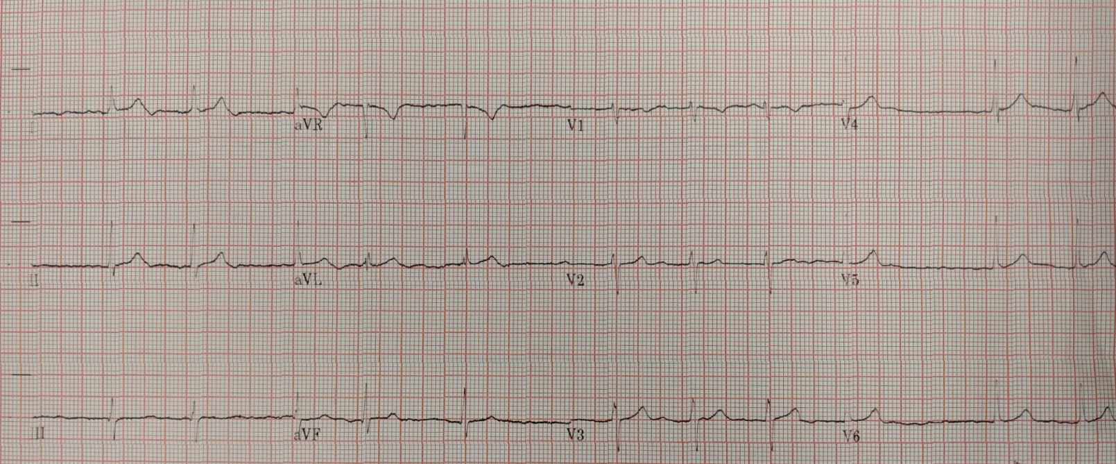 2019-12-figure1-ECG.jpg