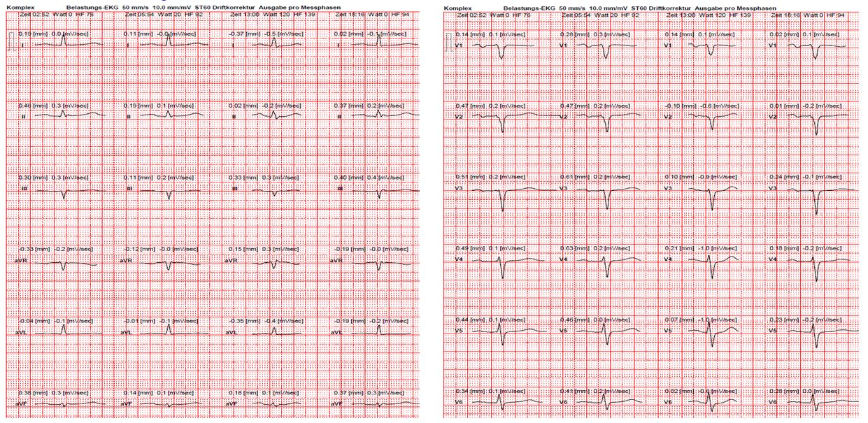 ecg-derivation-cpx-may-2018-case3.jpg