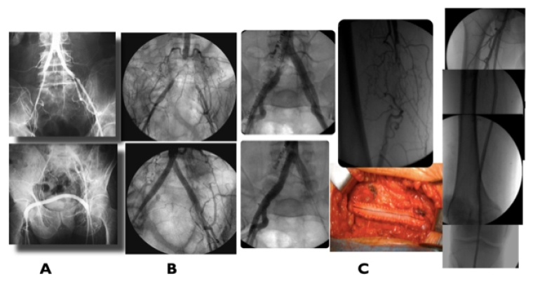 267_Fernandes_Figure 1_Peripheral arterial disease.jpg