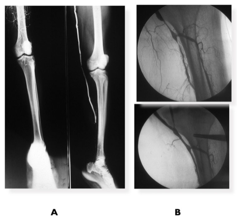 267_Fernandes_Figure 2 _Peripheral arterial disease.jpg