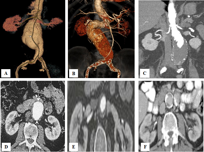 222_Davidovic_FIgure 1 - Is there a role for open repair of abdominal aortic aneurysms in the endovascular era.jpg