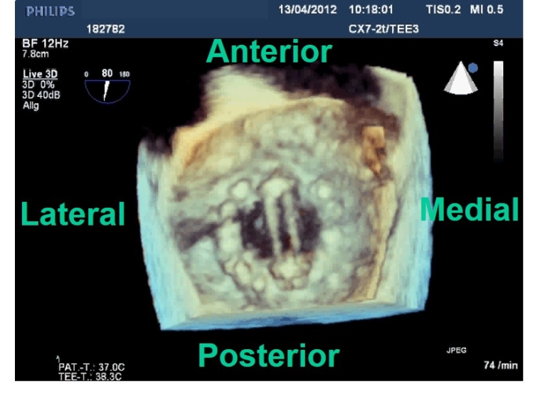 257_Brandt_Figure_1_Prosthetic heart valves Part 1 &ndash; Selection.jpg