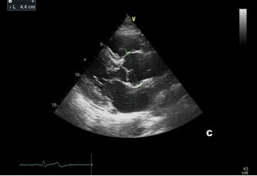 Fig C Flavio - Aortic root dilation in competitive athletes.jpg
