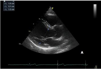 Fig A Flavio - Aortic root dilation in competitive athletes.jpg