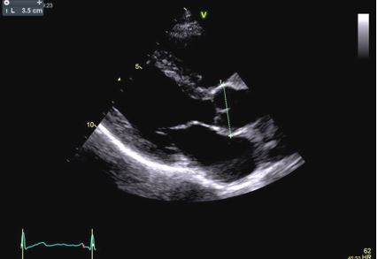 Fig 1 Flavio - Aortic root dilation in competitive athletes.jpg