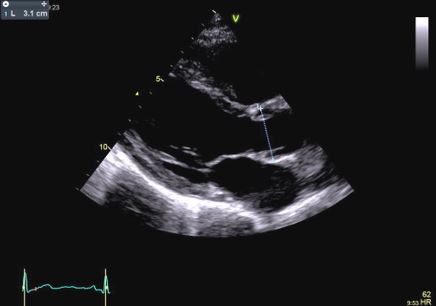 Fig 2 Flavio - Aortic root dilation in competitive athletes.jpg