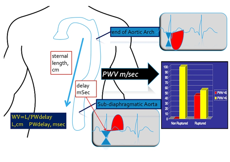 227_Russo_Figure 2_A new diagram and index to assess the risk of rupture of abdominal aortic aneurysms.jpg