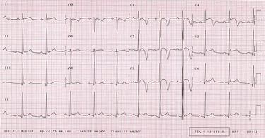 quiz-dec-ecg-1-case-web_escardio-hPhotoMedium.jpg