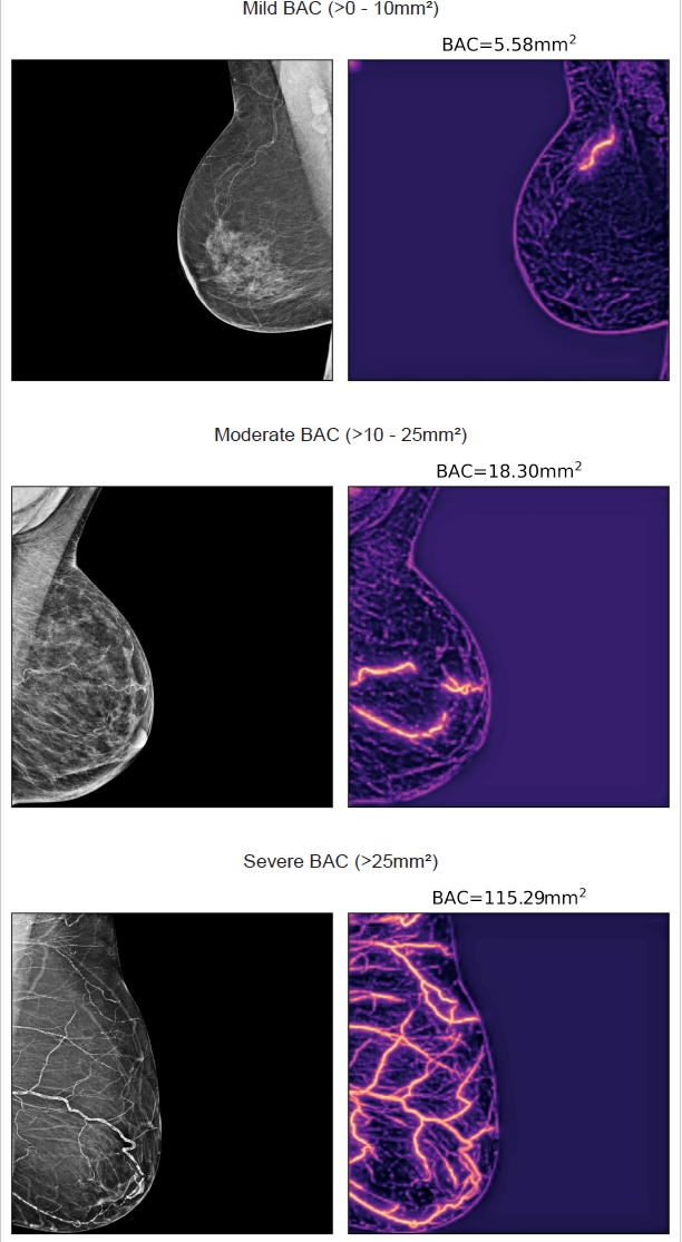 ] &lsquo;Artificial intelligence&ndash;based quantification of breast arterial calcifications to predict cardiovascular morbidity and mortality&rsquo;, by T. Dapamede et al., European Heart Journal, https://doi.org/10.1093/eurheartj/ehag128.