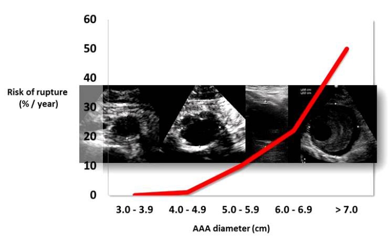 224_Corneli_Figure 1_Which patients should we screen to detect an aneurysm of the abdominal aorta.jpg