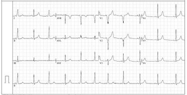 ecg-case-april-2014_escardio-hPhotoMedium.jpg