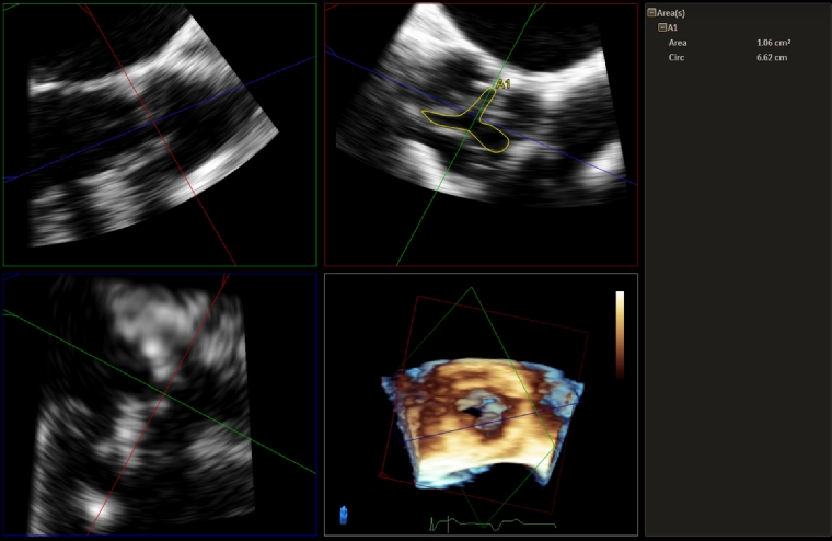 206_Wang_Figure 1._Advanced echocardiography in the evaluation of aortic valve disease.jpg
