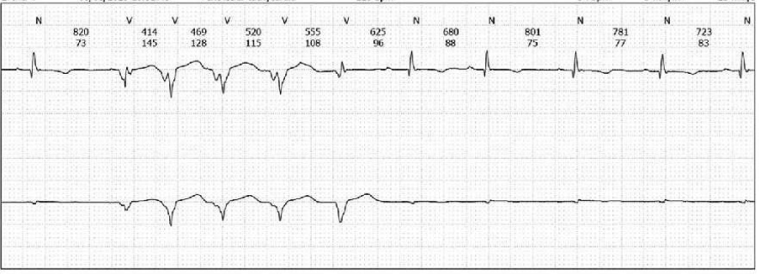 Clinical case Figure 5_The importance of the new ESC guidelines for the management of cardiomyopathies in non-dilated left ventricular cardiomyopathy.png