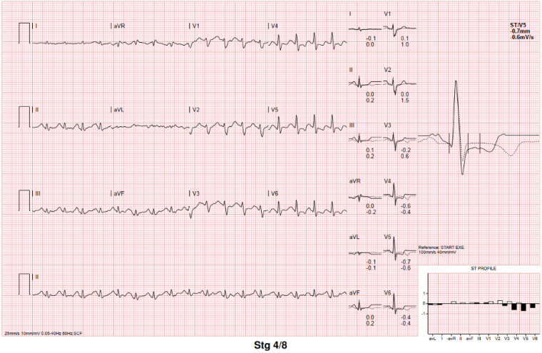 Clinical case Figure 4b_The importance of the new ESC guidelines for the management of cardiomyopathies in non-dilated left ventricular cardiomyopathy.png
