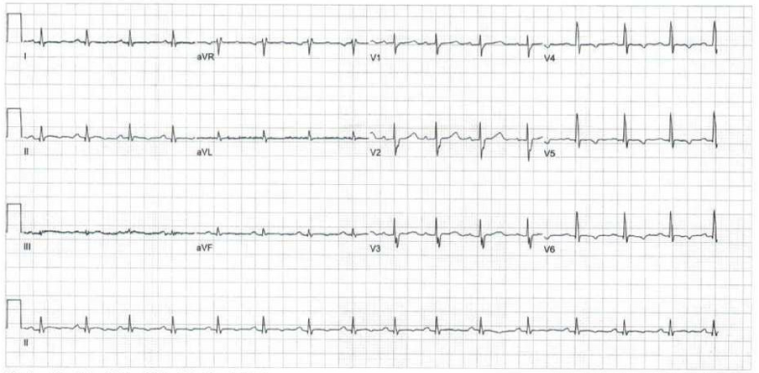 Clinical case Figure 2_The importance of the new ESC guidelines for the management of cardiomyopathies in non-dilated left ventricular cardiomyopathy.png