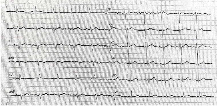Figure 1 - Is it mitral valve prolapse or Titin cardiomyopathy that led to sudden cardiac arrest.jpg