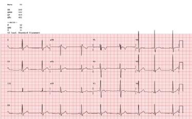 ECGImage_QuizMay2017_escardio-hPhotoMedium.jpg