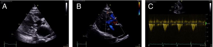 Fig 4 CC - Clinical Case - hypertrophic cardiomyopathy.jpg