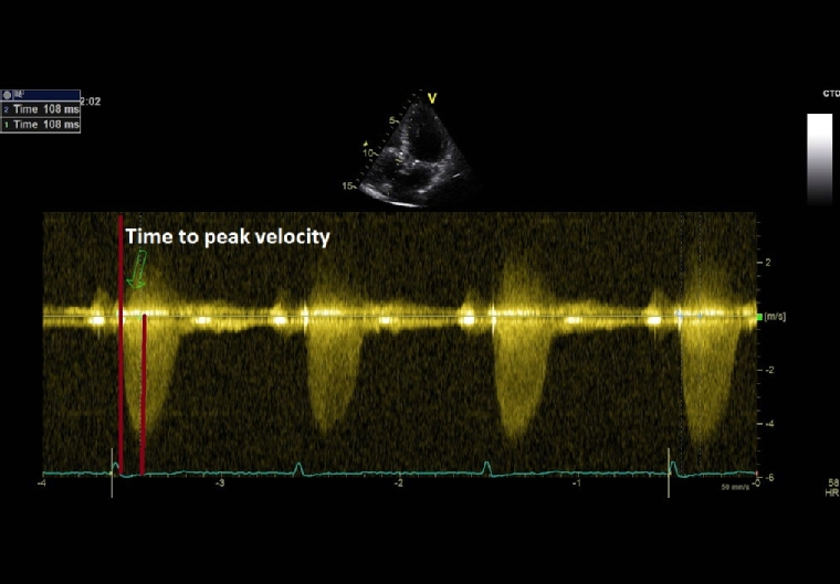 209_Siliste_Figure 1_Physical examination in aortic valve disease do we still need it in the modern era.jpg