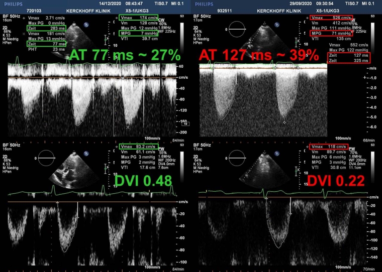 260_Brandt_Figure 2_Prosthetic heart valves Part 4.jpg