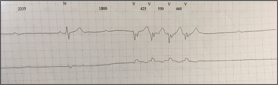 Clinical case_ Fig 2 - The importance of early etiologic diagnosis of dilated cardiomyopathy.jpg