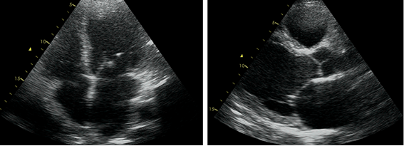 Clinical case_ Fig 3 - The importance of early etiologic diagnosis of dilated cardiomyopathy.png