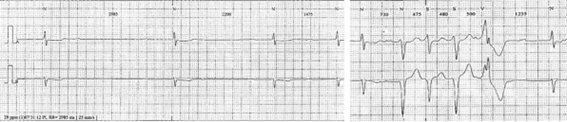 Clinical case_ Fig 1 6 The importance of early etiologic diagnosis of dilated cardiomyopathy.png